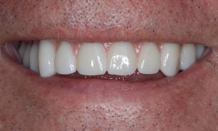Mans mouth after implant dentures, nashville tn