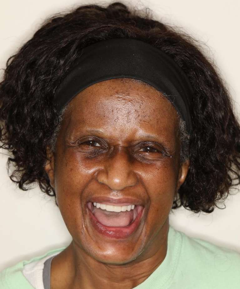 Black womans mouth after implant dentures, nashville tn