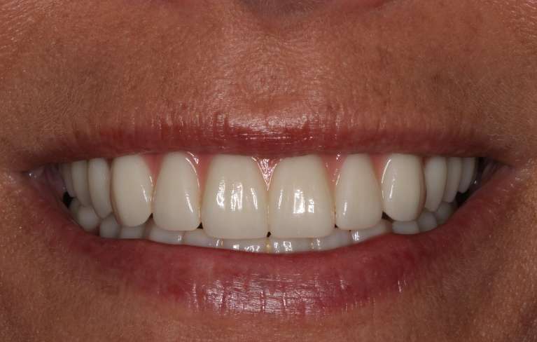 Mouth after implant-supported dentures, nashville tn