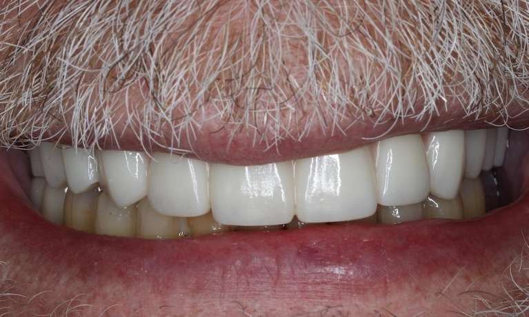 Close of older mans teeth with a white mustache after implant-supported dentures, Nashville tn