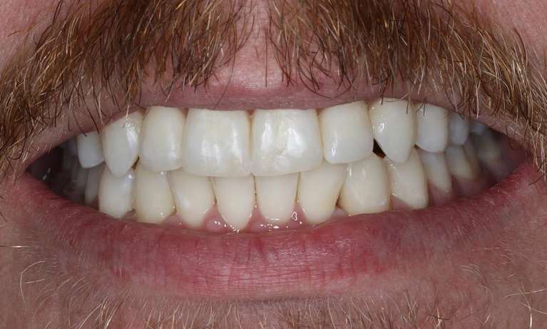 Invisalign-LANAP-After-Image