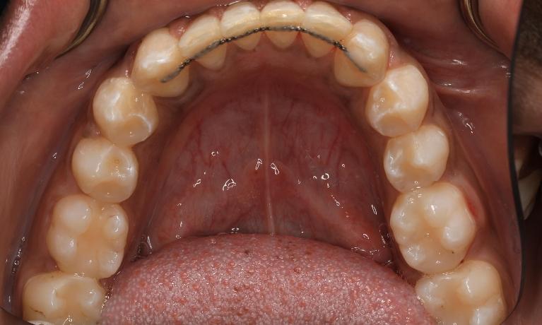 Patient teeth after Invisalign Brentwood, TN