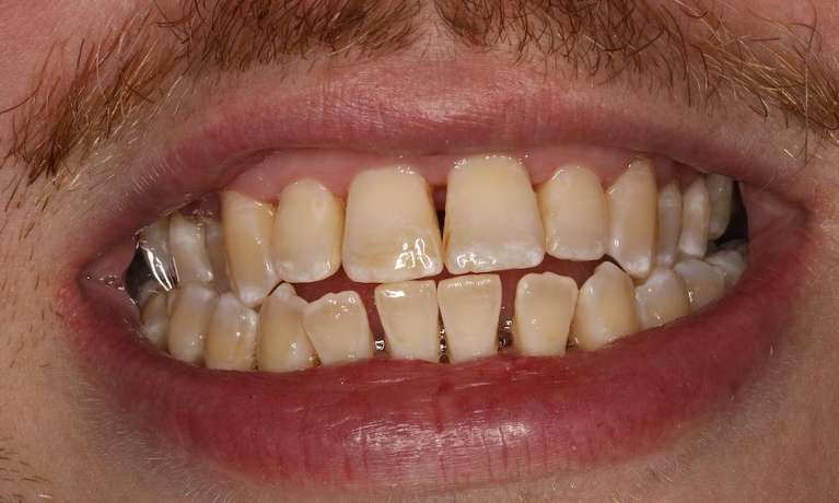 LANAP-Laser-Periodontal-Treatment-After-Image