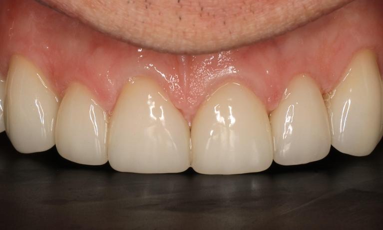 Smile-Makeover-Crowns-Sleep-Apnea-Treatment-After-Image