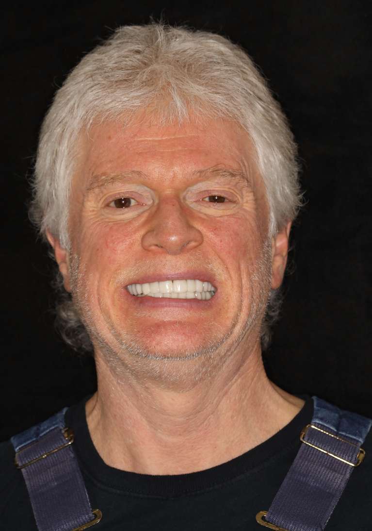 Smile-Makeover-After-Image