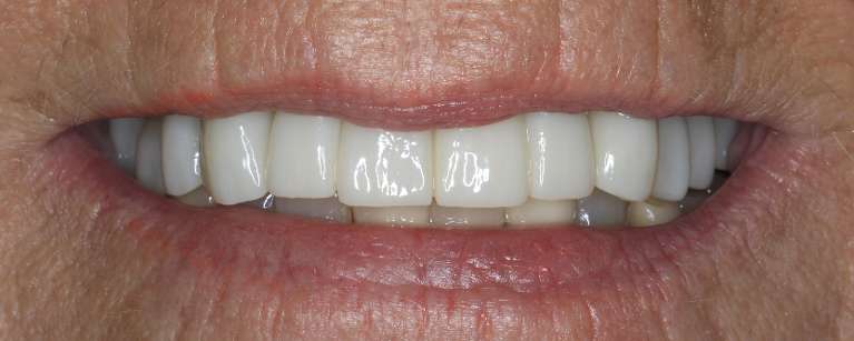 Smile-Makeover-After-Image