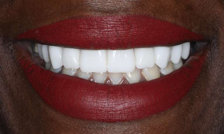 Smile-Makeover-After-Image