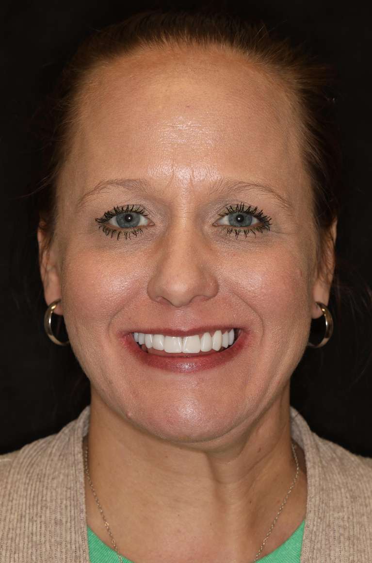 After a smile makeover picture of a woman smiling in nashville, tn 