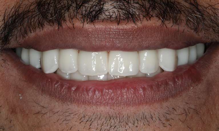 Close up of man smiling after all-on-x implant dentures, nashville tn