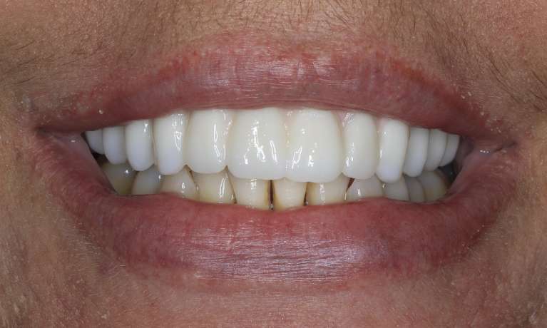 Close up view of middle aged woman smiling after all-on-x implant dentures, nashville tn