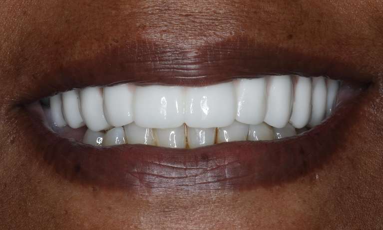 Close up view of woman smiling after all-on-x implant dentures, nashville tn