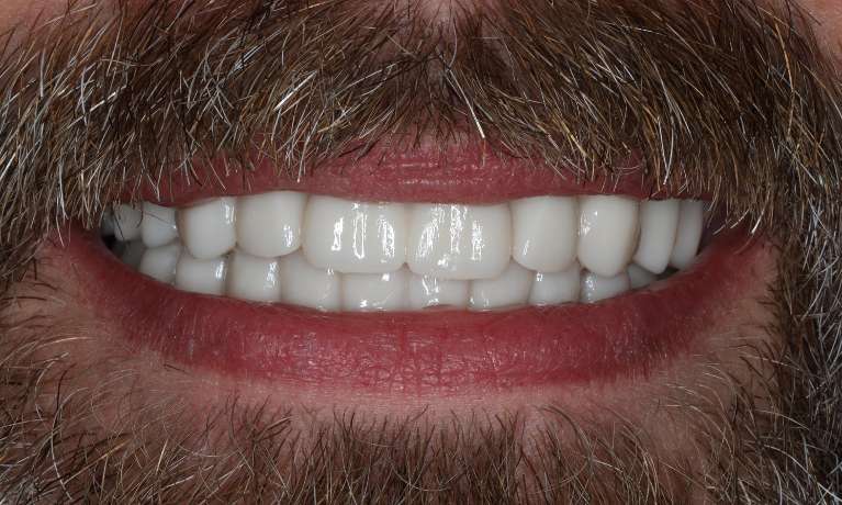 Close up view of bald man smiling after all-on-x implant dentures, nashville tn