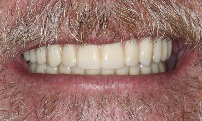 Close up view of older man smiling after all-on-x implant dentures, nashville tn