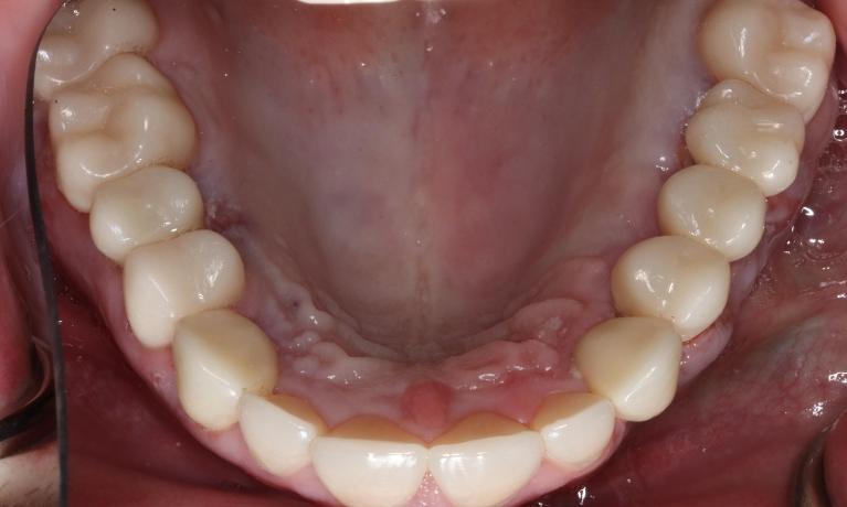 Overhead view of mouth after complete smile makeover, nashville tn