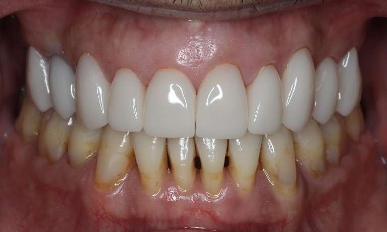 Close up of mans gums after cosmetic crowns, brentwood tn