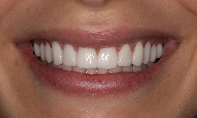 Close up of womans mouth after getting cosmetic/cerec crowns in brentwood, tn