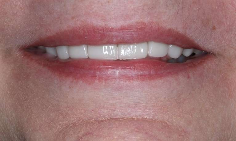Close up of an older woman after CEREC cosmetic crowns, brentwood tn