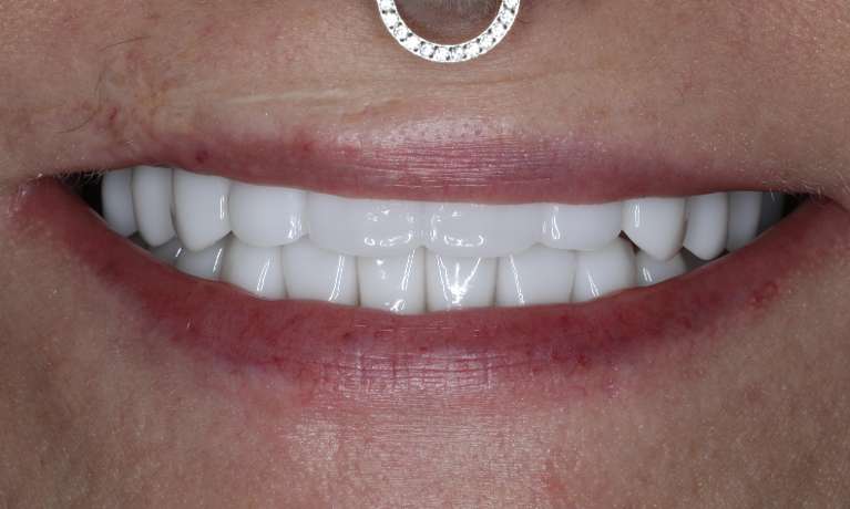 Close up view of after full mouth smile makeover, nashville tn