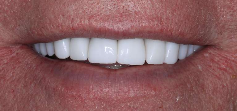 Close up of man smiling after full smile makeover, nashville tn