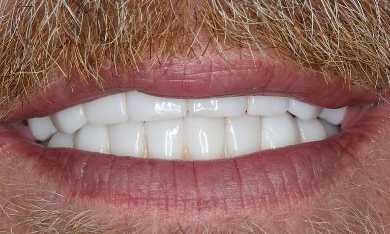 Close of mans mouth with mustache after implant-supported dentures, Nashville tn