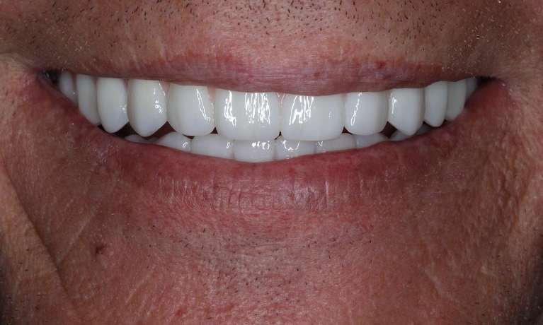 Mouth after Upper and Lower Implant-Supported Dentures, nashville tn