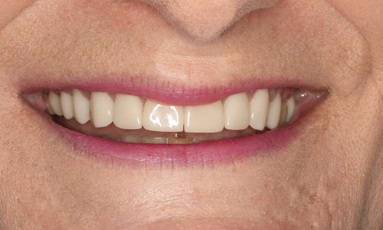 Close up of older womans mouth after cosmetic crowns, brentwood tn