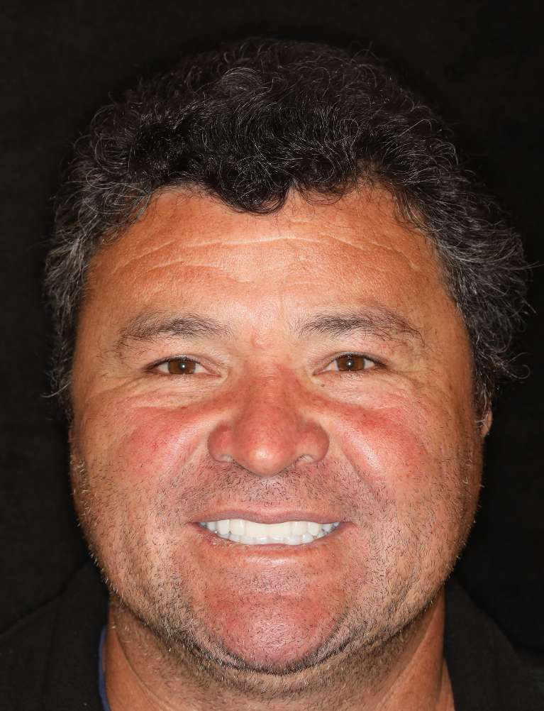 Nashville implant supported dentures- After Photo