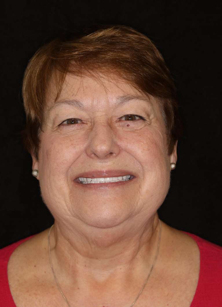Older woman with brown hair after cosmetic crowns, brentwood tn
