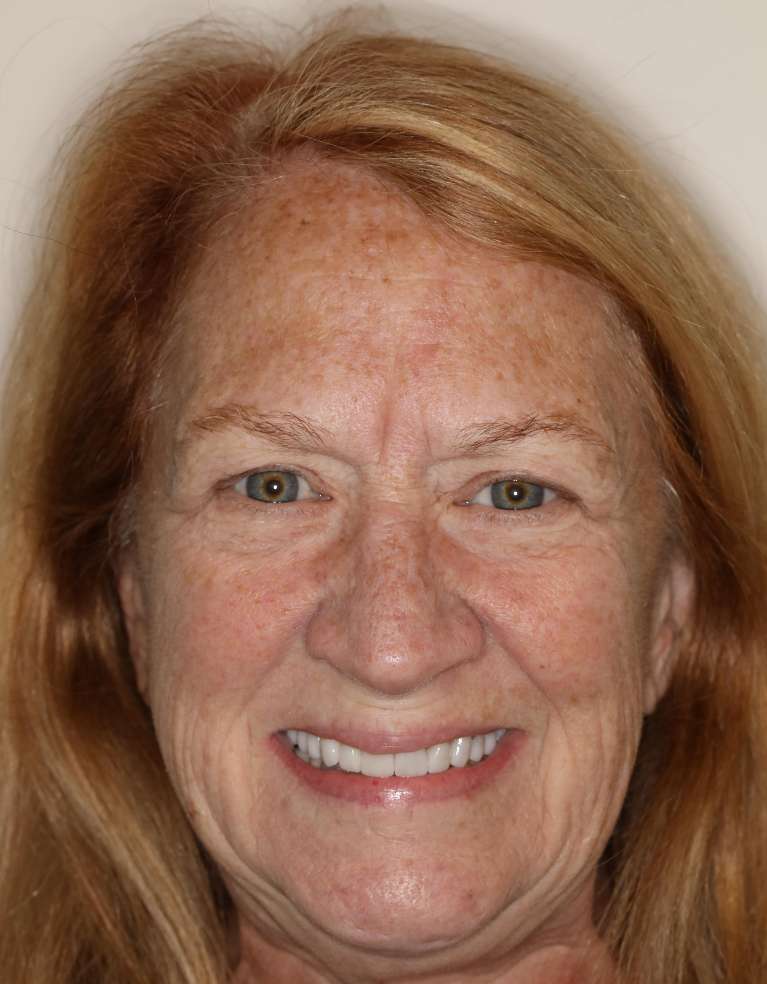 Invisalign in Brentwood, TN- After Photo