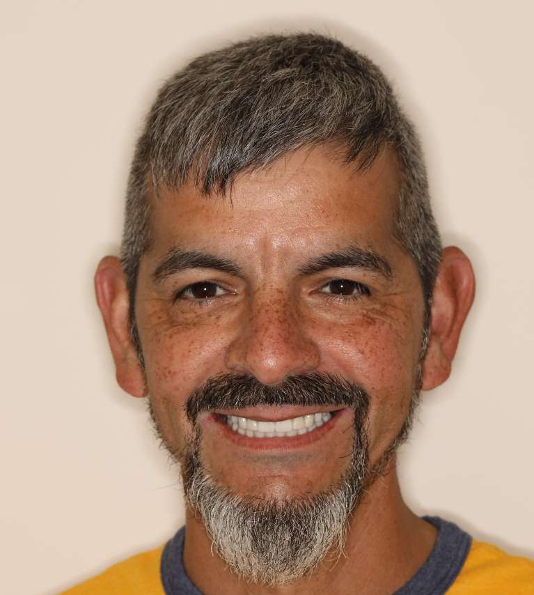 Nashville implant dentures- After Photo