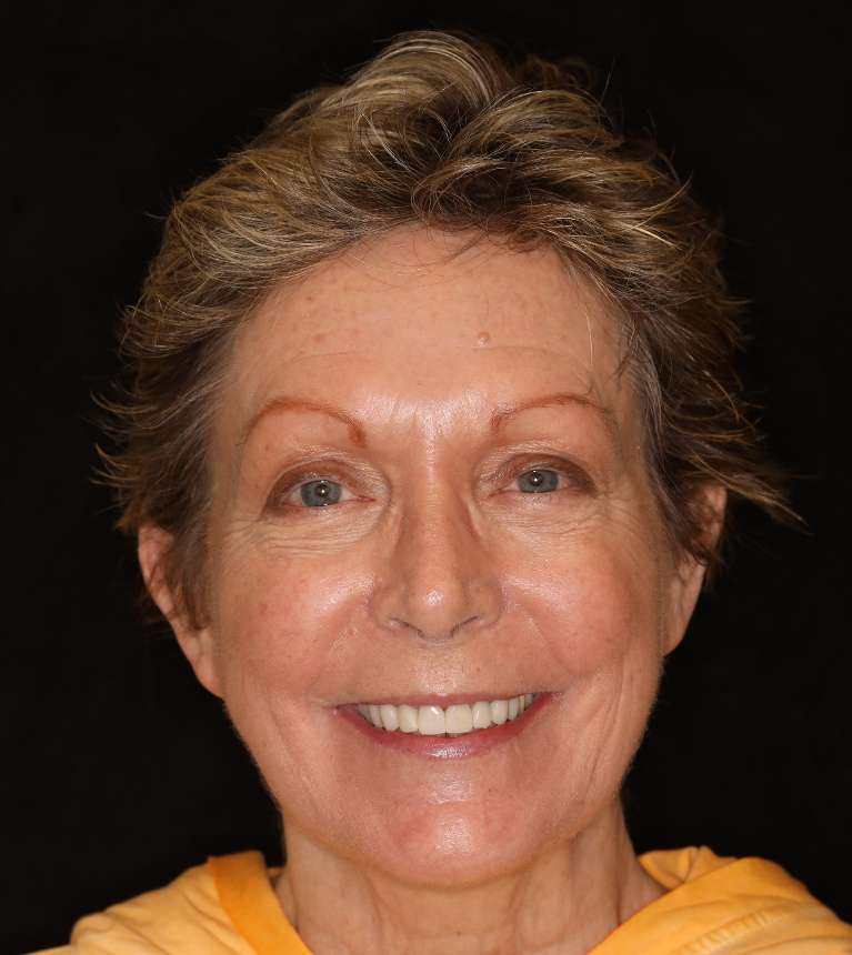 Brentwood CEREC Crowns- After Photo