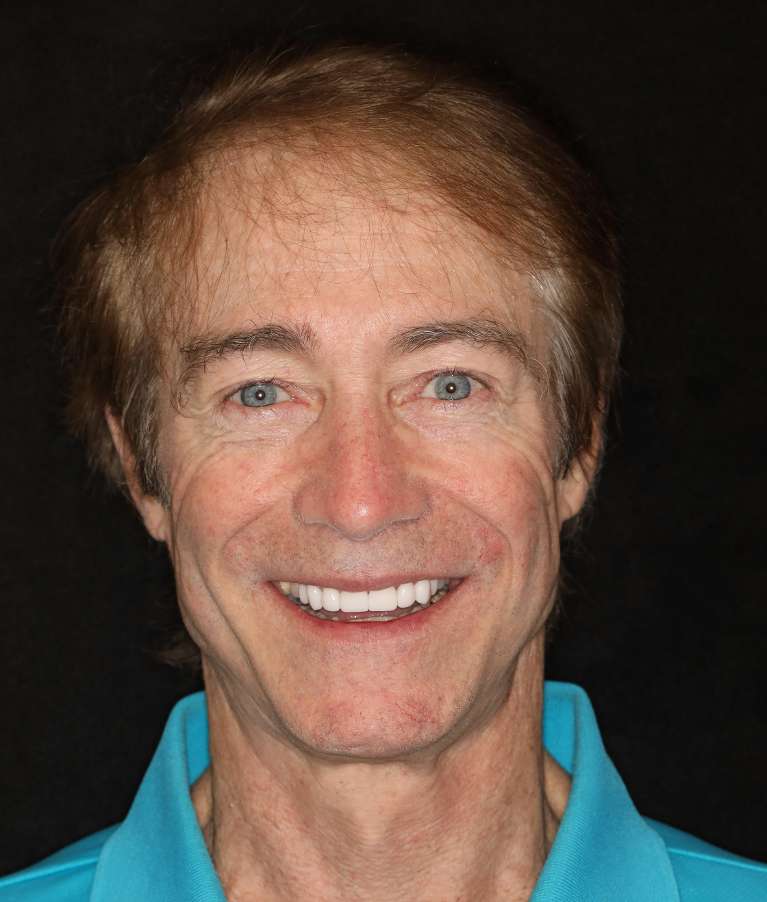 dental crowns Brentwood, TN- After Photo