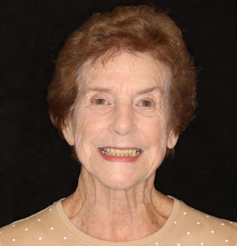 Elderly woman smiling before all-on-x implant dentures, nashville tn