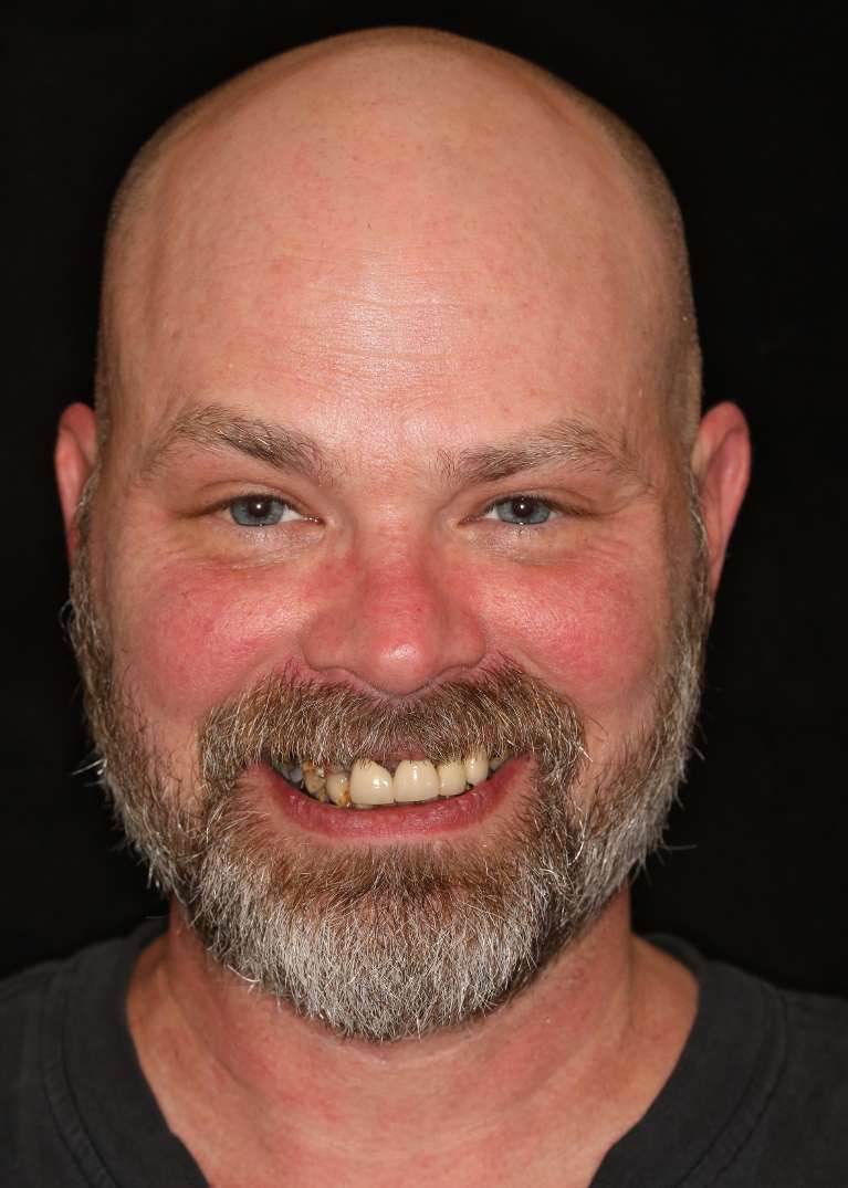 Bald man smiling before all-on-x implant dentures, nashville tn