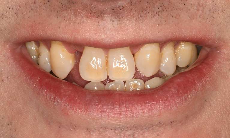 Before cosmetic crowns and bridges in Brentwood, TN