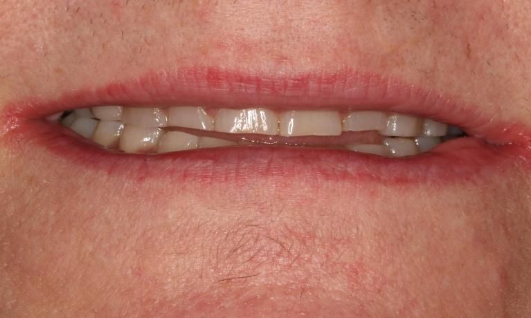 Patient used to grind teeth Brentwood, TN