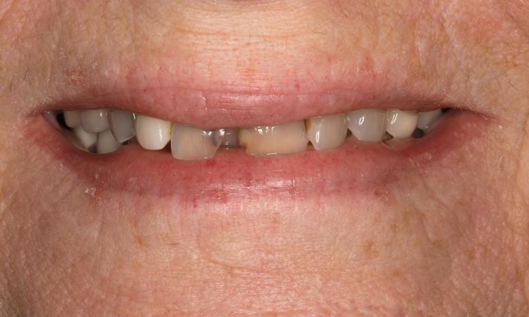 before picture of smile makeover in brentwood tn