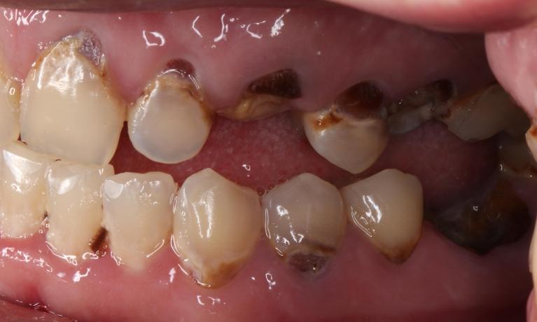 Close up of mouth from a side view before a complete smile makeover, nashville tn