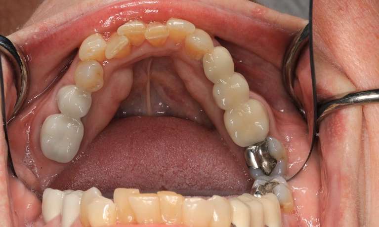 Cosmetic-Crowns-Invisalign-Before-Image