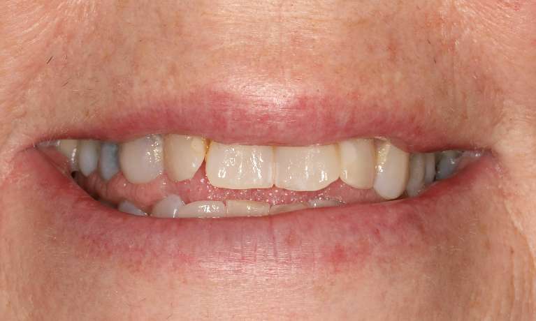 Patient teeth before cosmetic crowns Brentwood, TN