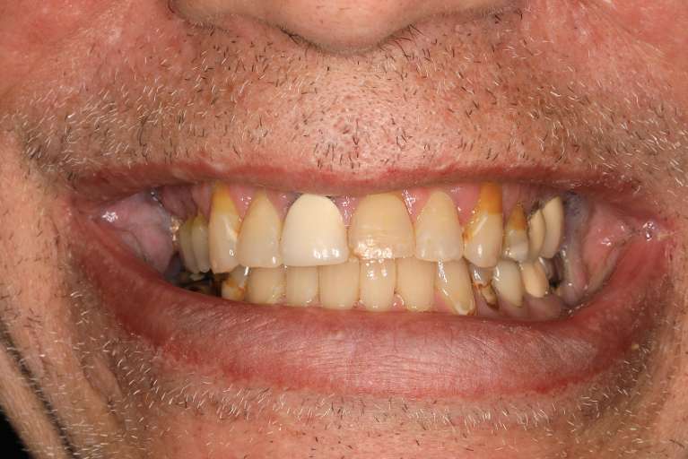 Close up of mans mouth before cosmetic crowns