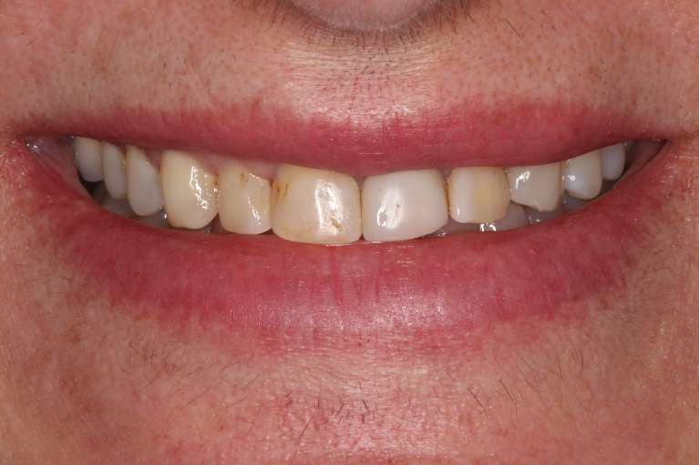 Womans smile before cosmetic crowns, nashville tn