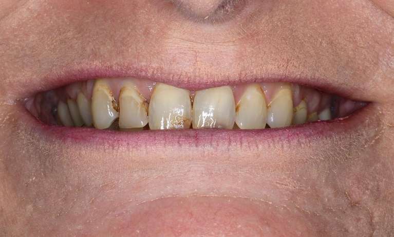 Close up of older womans mouth before cosmetic crowns, brentwood tn