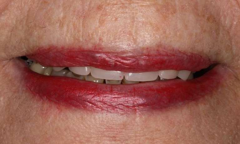 Close up view of elderly womans mouth before cosmetic crowns, brentwood tn