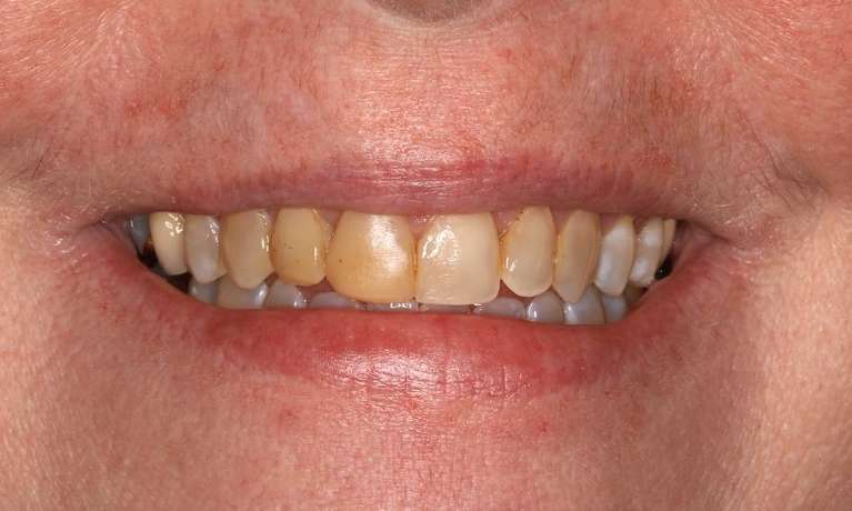 Close up view of womans mouth before cosmetic crowns, brentwood tn