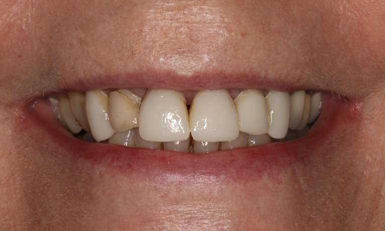 Close up of mouth before cosmetic crowns, brentwood tn