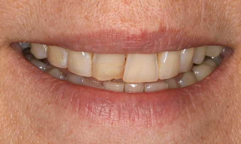 Before cosmetic dentistry in Brentwood, TN