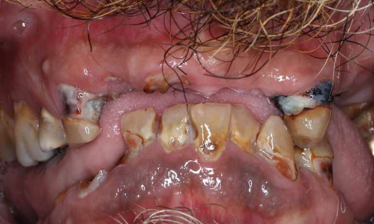 Close up of mouth before dentures, brentwood tn