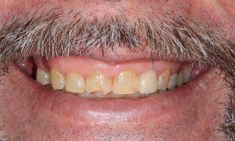 Patient teeth before full mouth makeover Brentwood, TN