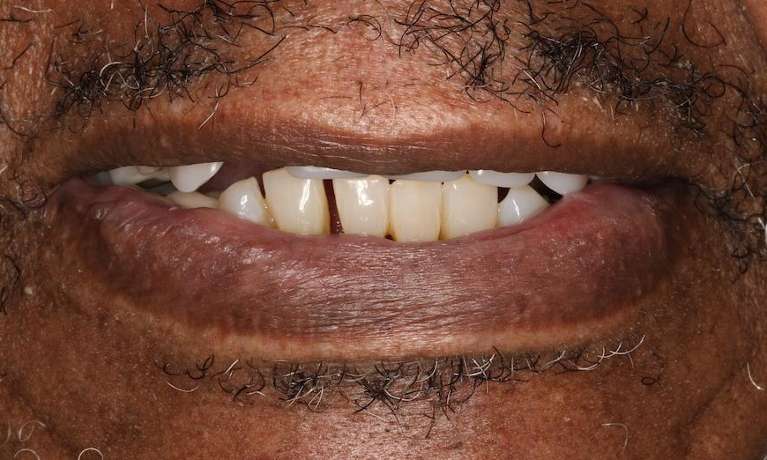 Close up view of black mans mouth before implant dentures, nashville tn